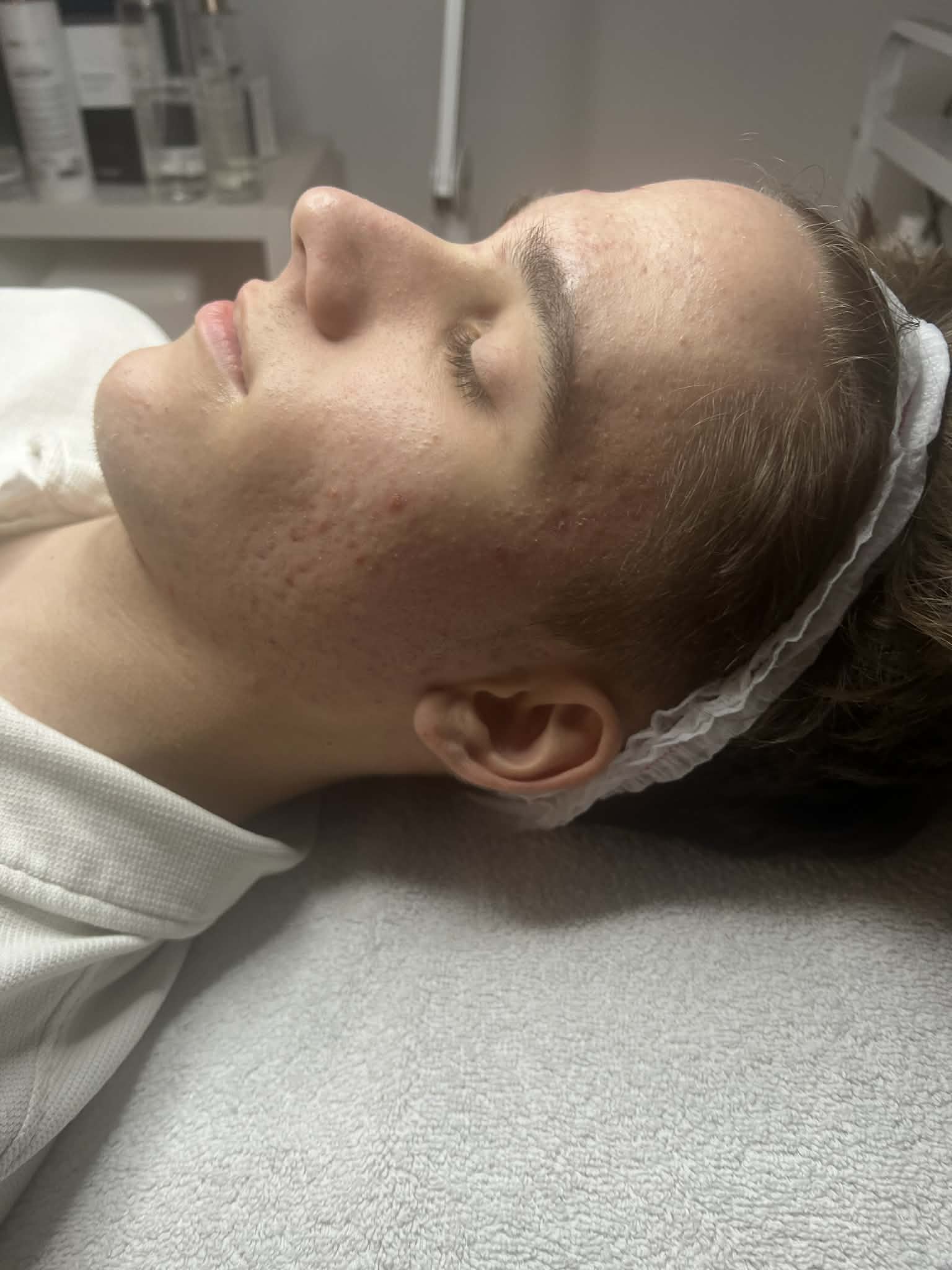 Akné Terápia Hydratouch Kezelés Után