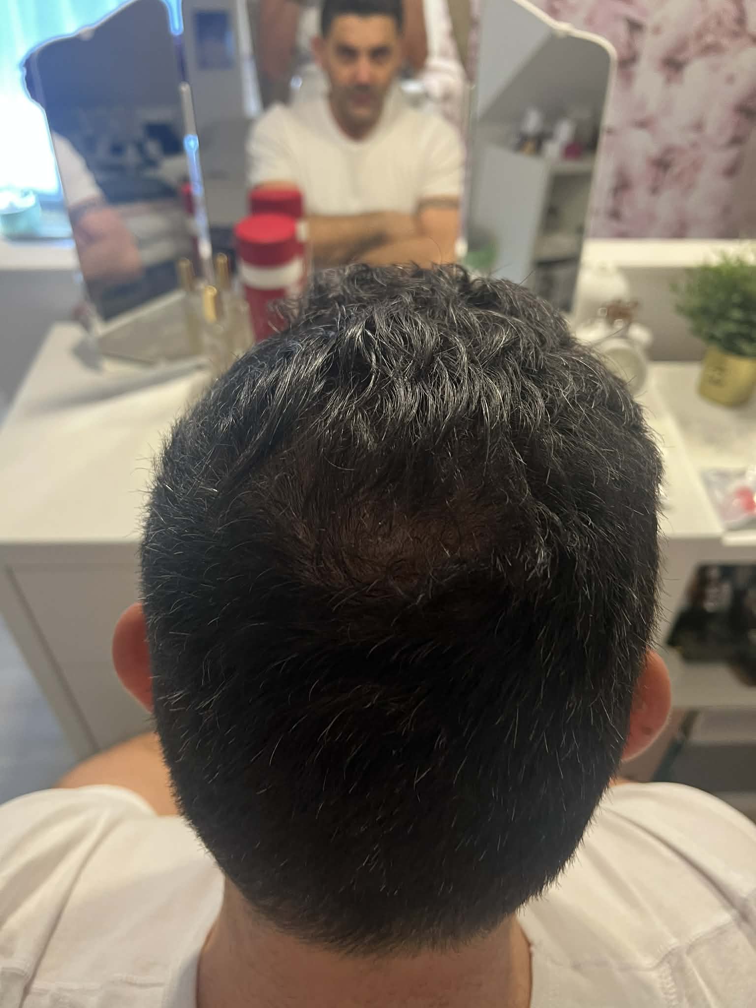 Biopen Hajmezoterápia Kezelés Után