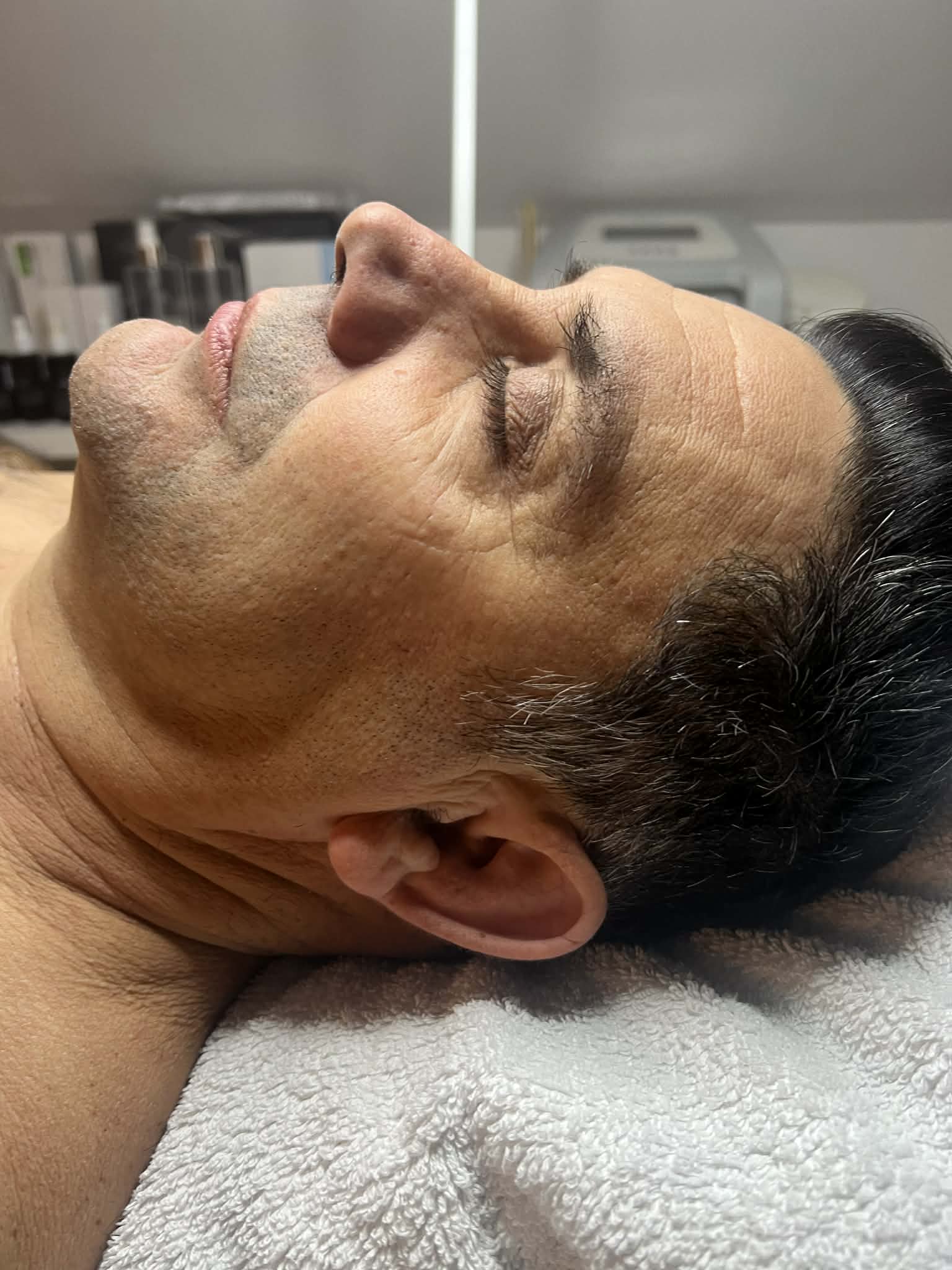 Carboxy Terápia Előtt