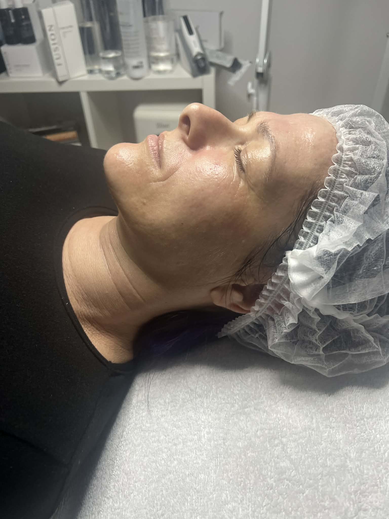 Hydratouch Kezelés Után