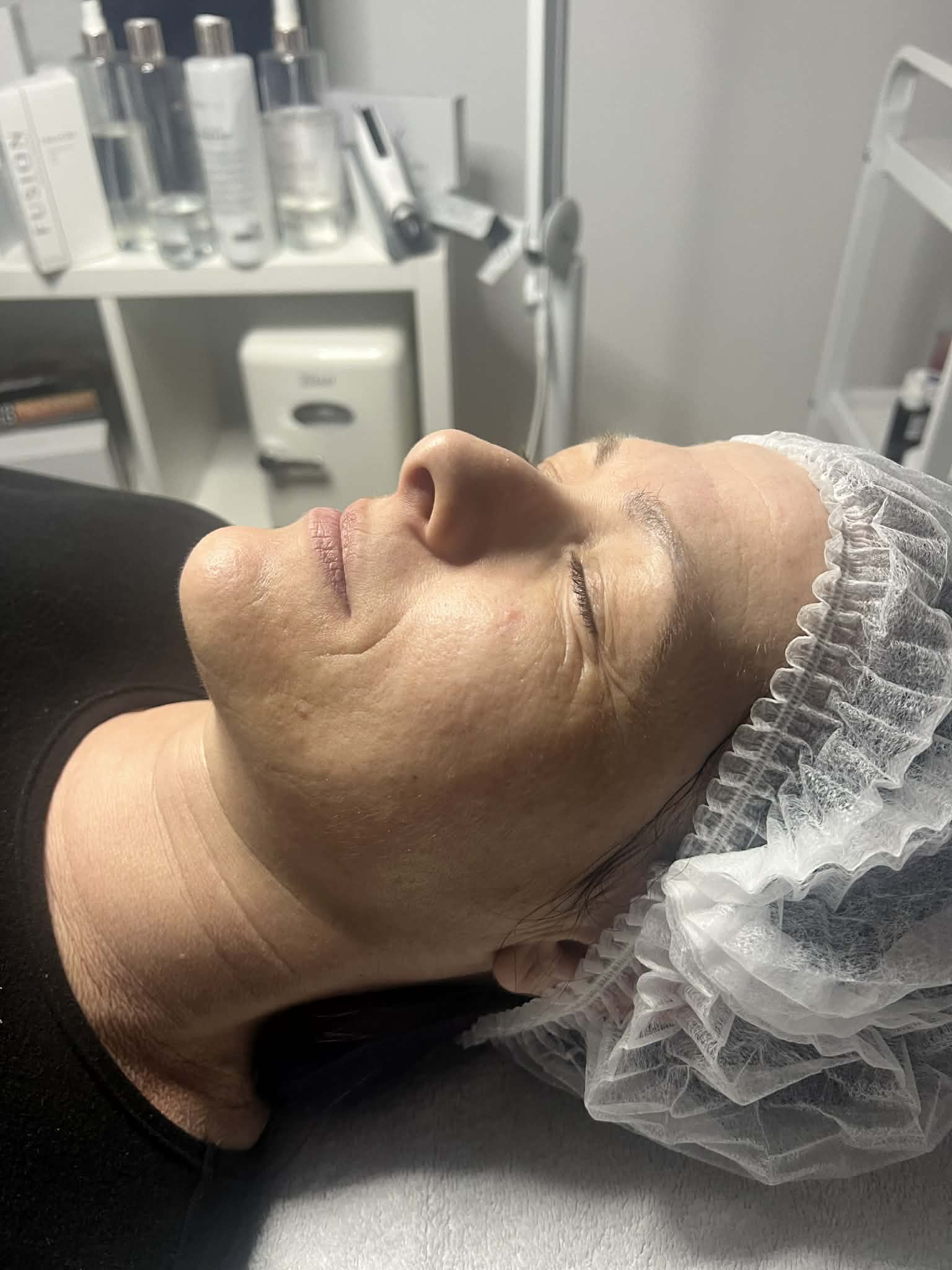 Hydratouch Kezelés Előtt