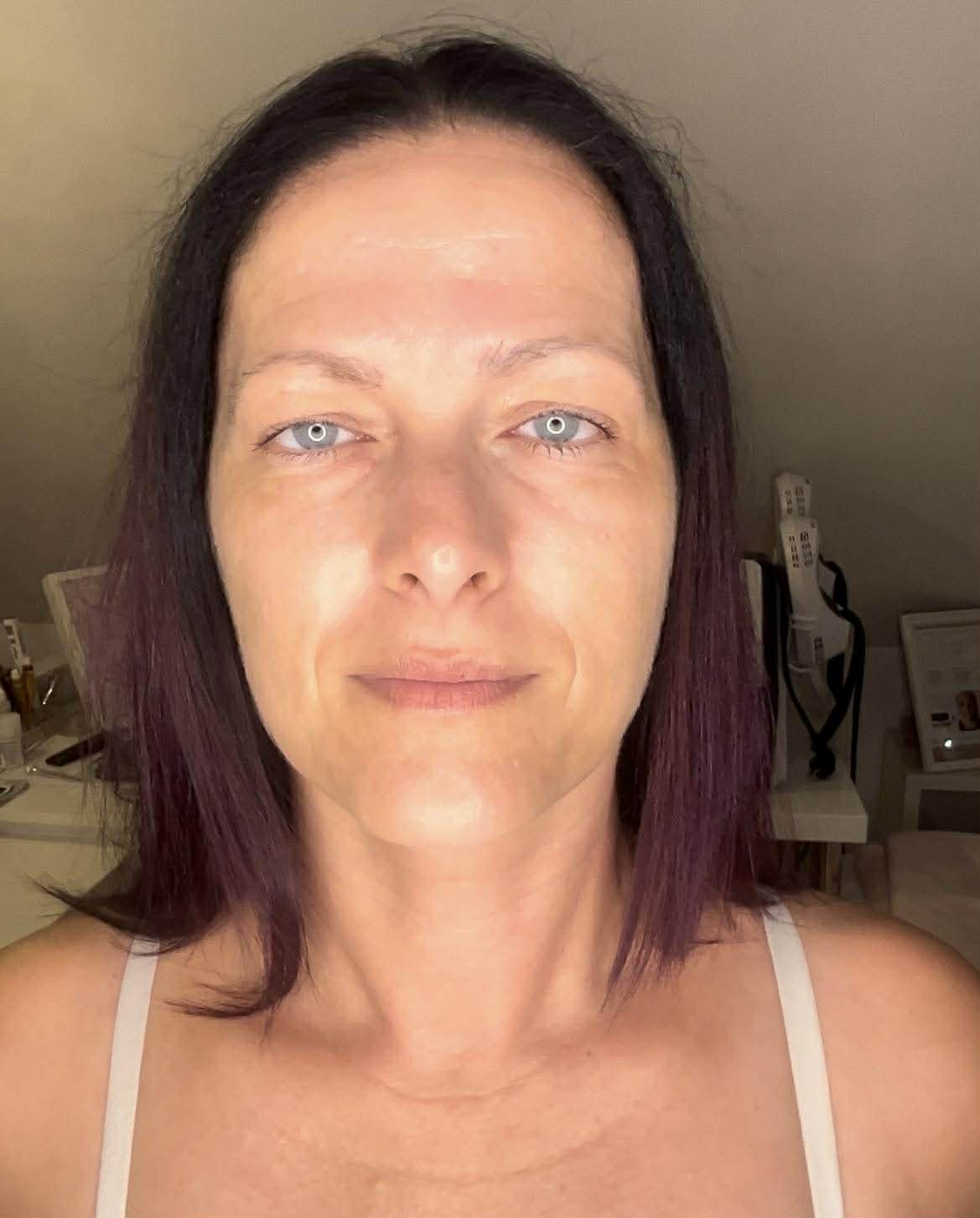 Mezopen Kezelés Után