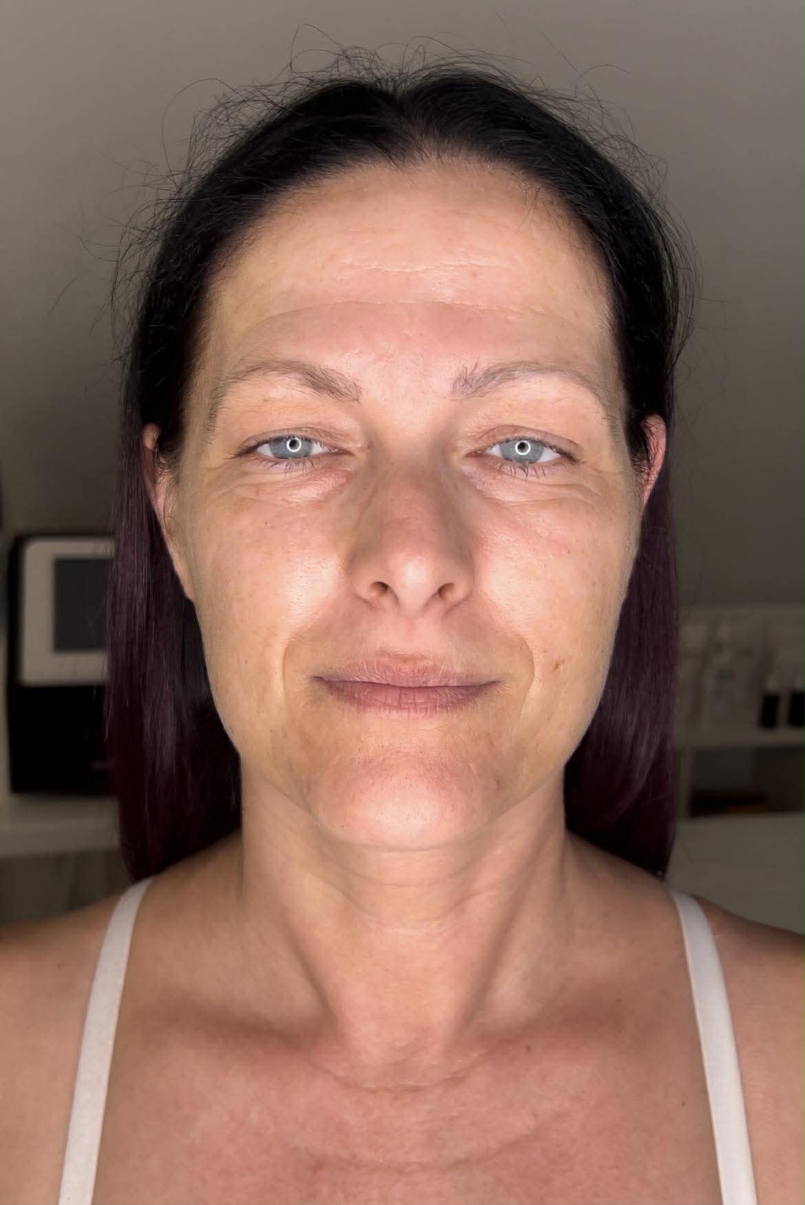 Mezopen Kezelés Előtt