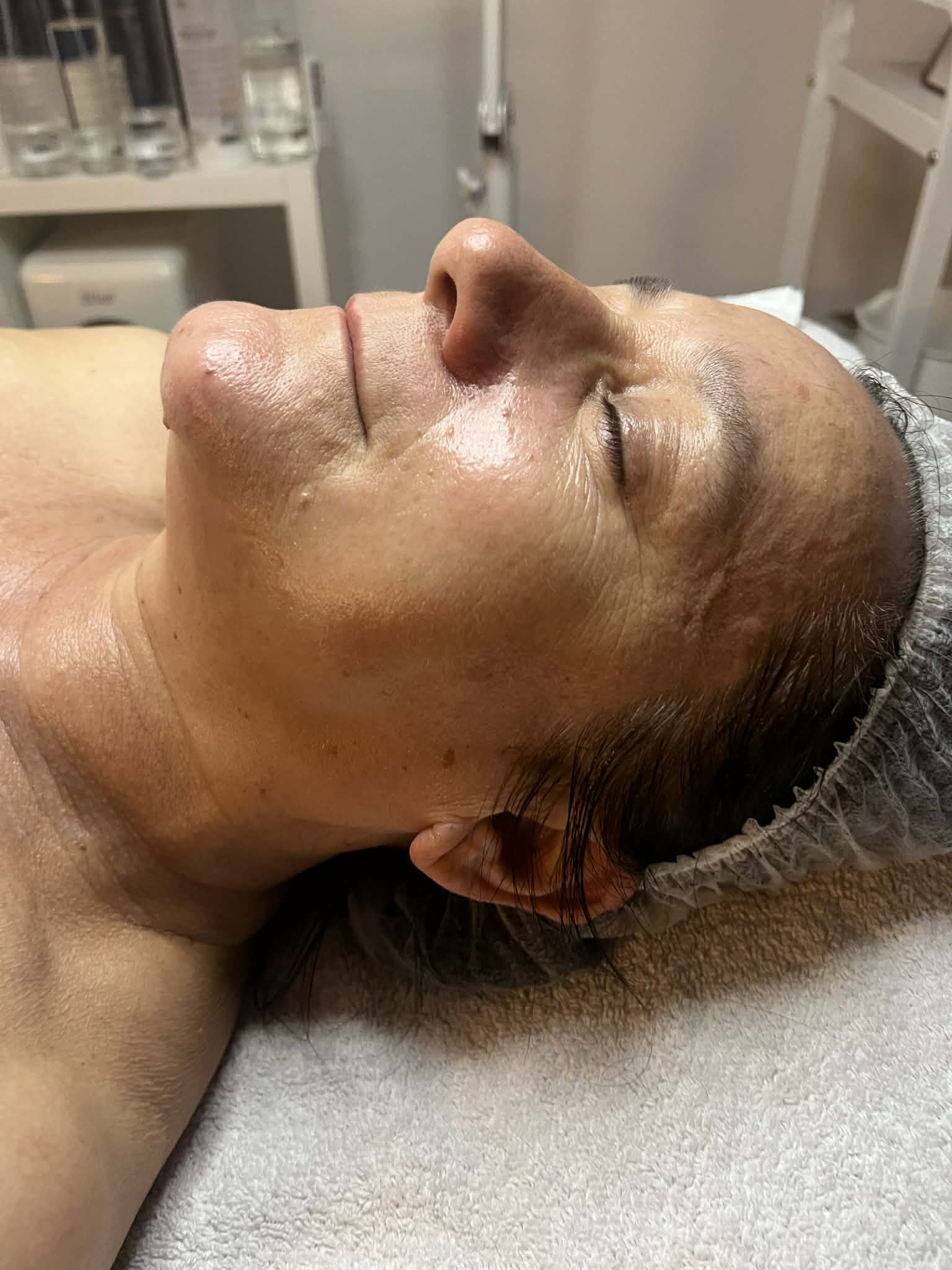 Skin Booster Aquapen Kezelés Után