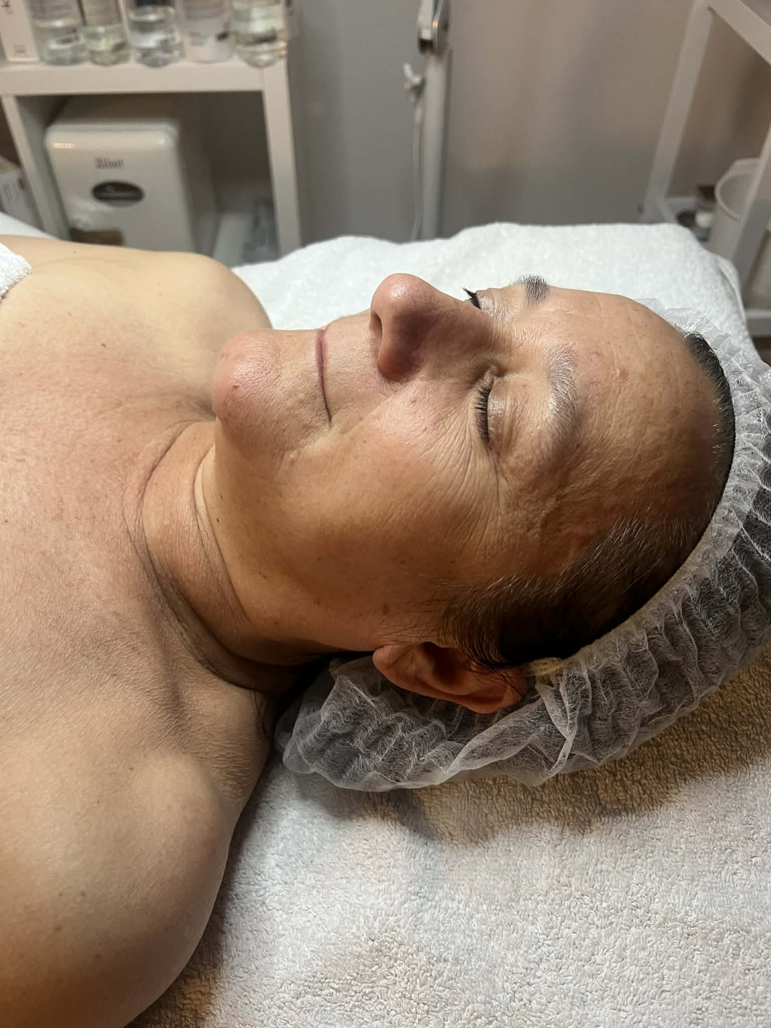 Skin Booster Aquapen Kezelés Előtt