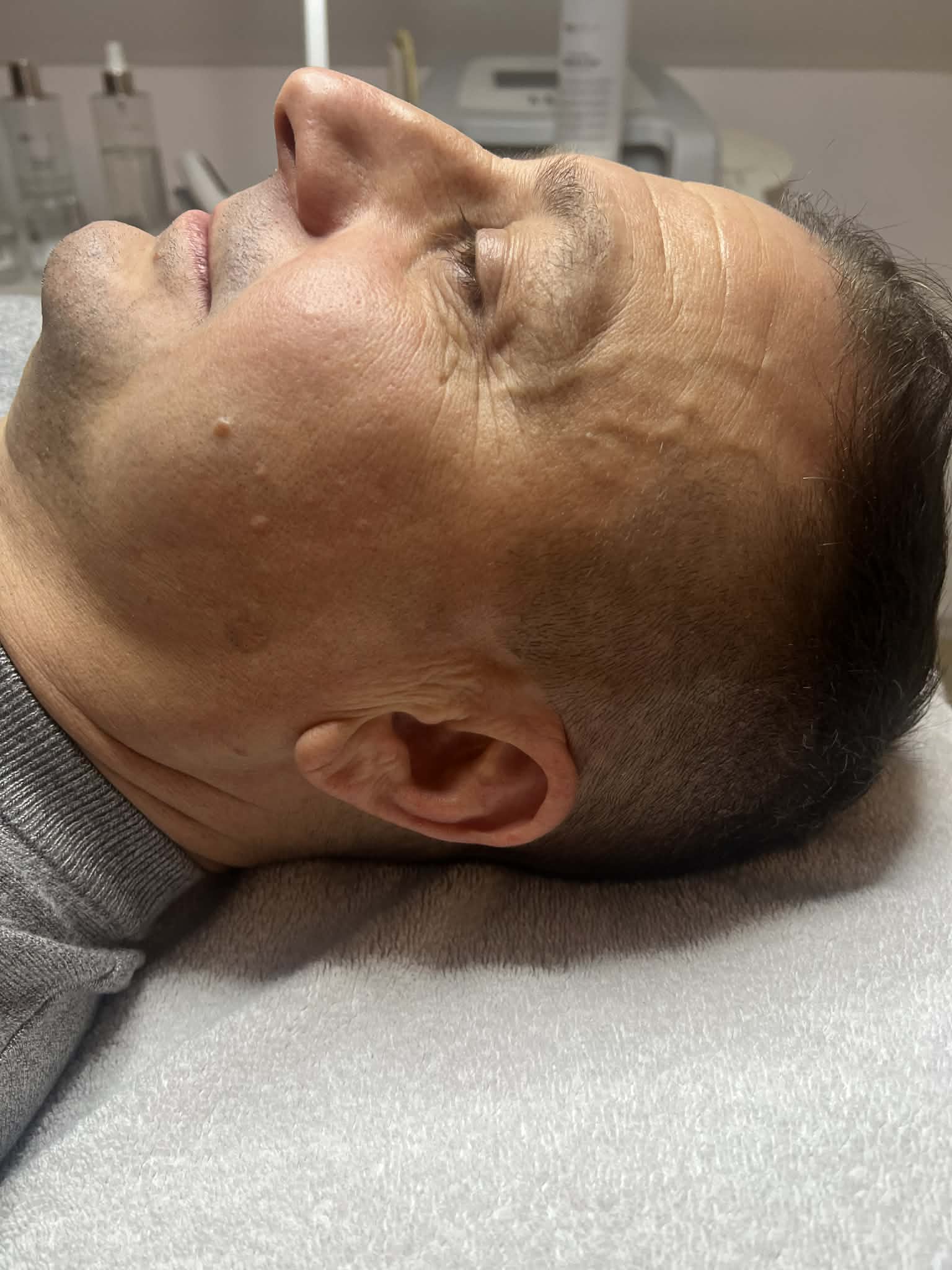 Thermage Kezelés Előtt