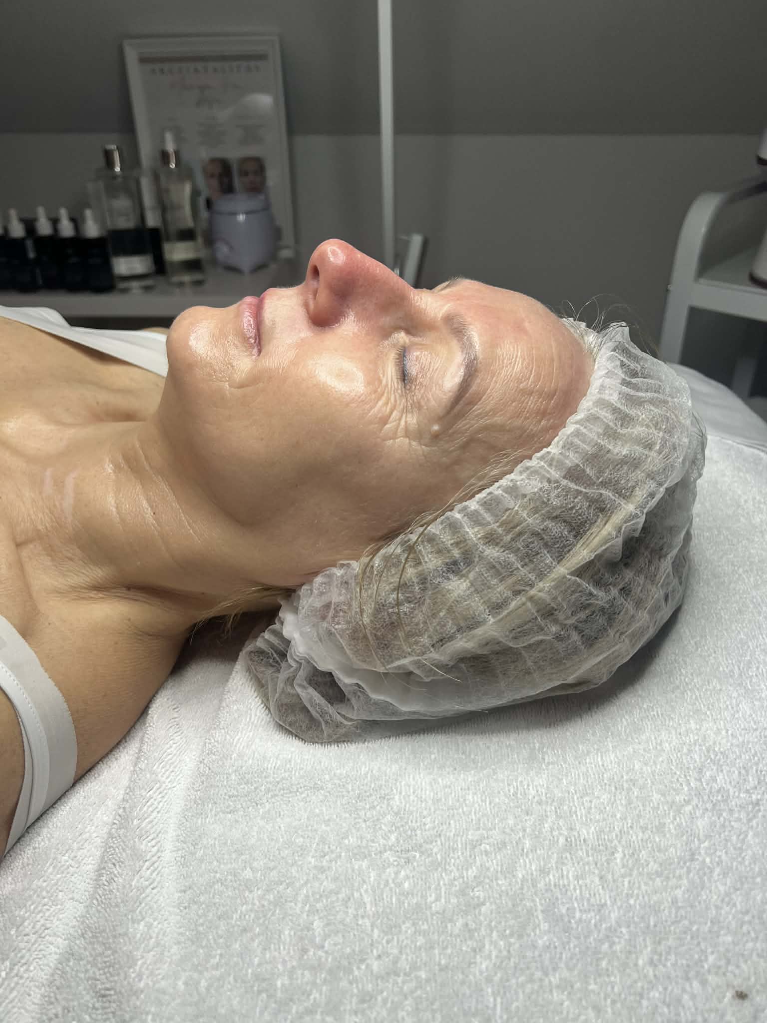 Thermage Kezelés Után